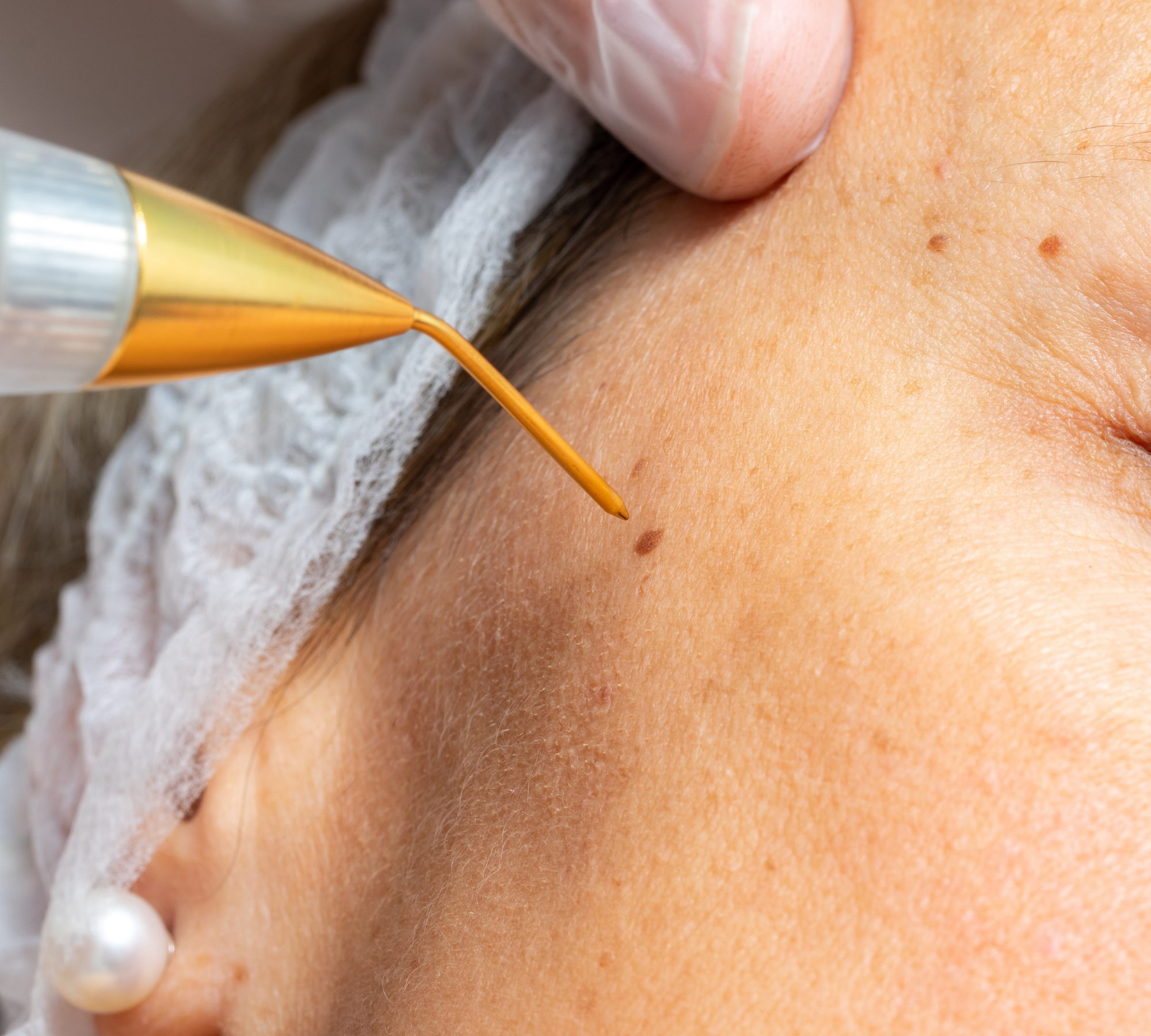 Close-up of aSKN AESTHETICS NZ warts removal treatment on a person's face.